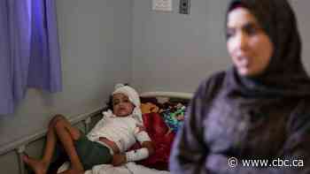 Burn patients face intense recovery amid drug shortage under Israeli blockade of Gaza