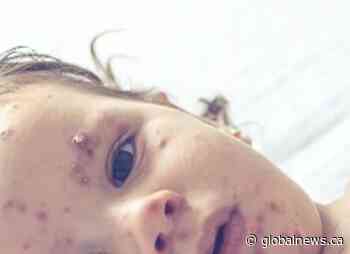 Confirmed cases of measles in Alberta now at 326, continue to rise