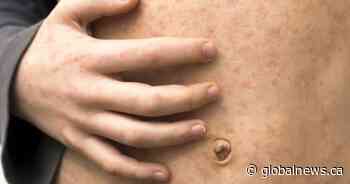 AHS warns of possible measles exposures in Taber, Whitecourt and Grimshaw