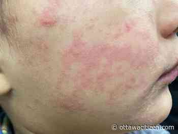 Ontario measles outbreak at more than 1,600 cases