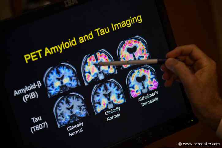 FDA OKs first blood test that can help diagnose Alzheimer’s disease