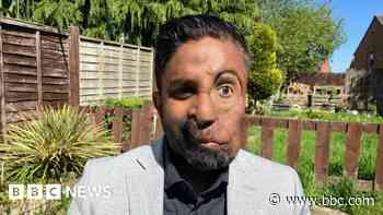 'I was refused service in a cafe because of my face'