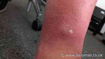 Britain's most dangerous spider strikes in Hertfordshire: Man is left in 'unbearable' pain and struggling to walk after bite from noble false widow