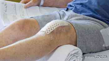 It's much faster to get hip or knee replacements if there's a central waitlist: study