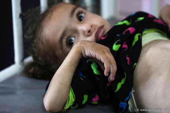 Gaza’s main hospital is overwhelmed with children in pain from malnutrition