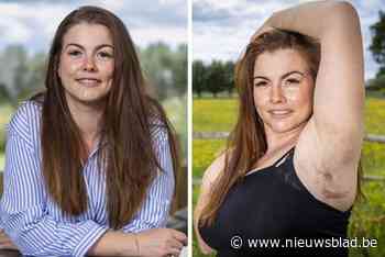 Dephny (30) lijdt aan pijnlijke huidziekte die zelfs nog bij veel artsen onbekend is: “In de spiegel kijken is nog altijd lastig”