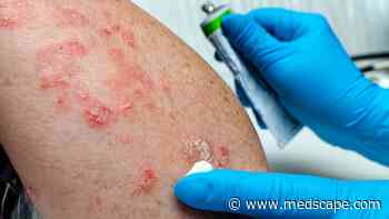 Experts Define On-Treatment Remission for Plaque Psoriasis