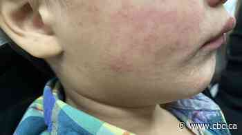 Consider measles risks in spring break vacation plans, health officials urge Manitoba parents