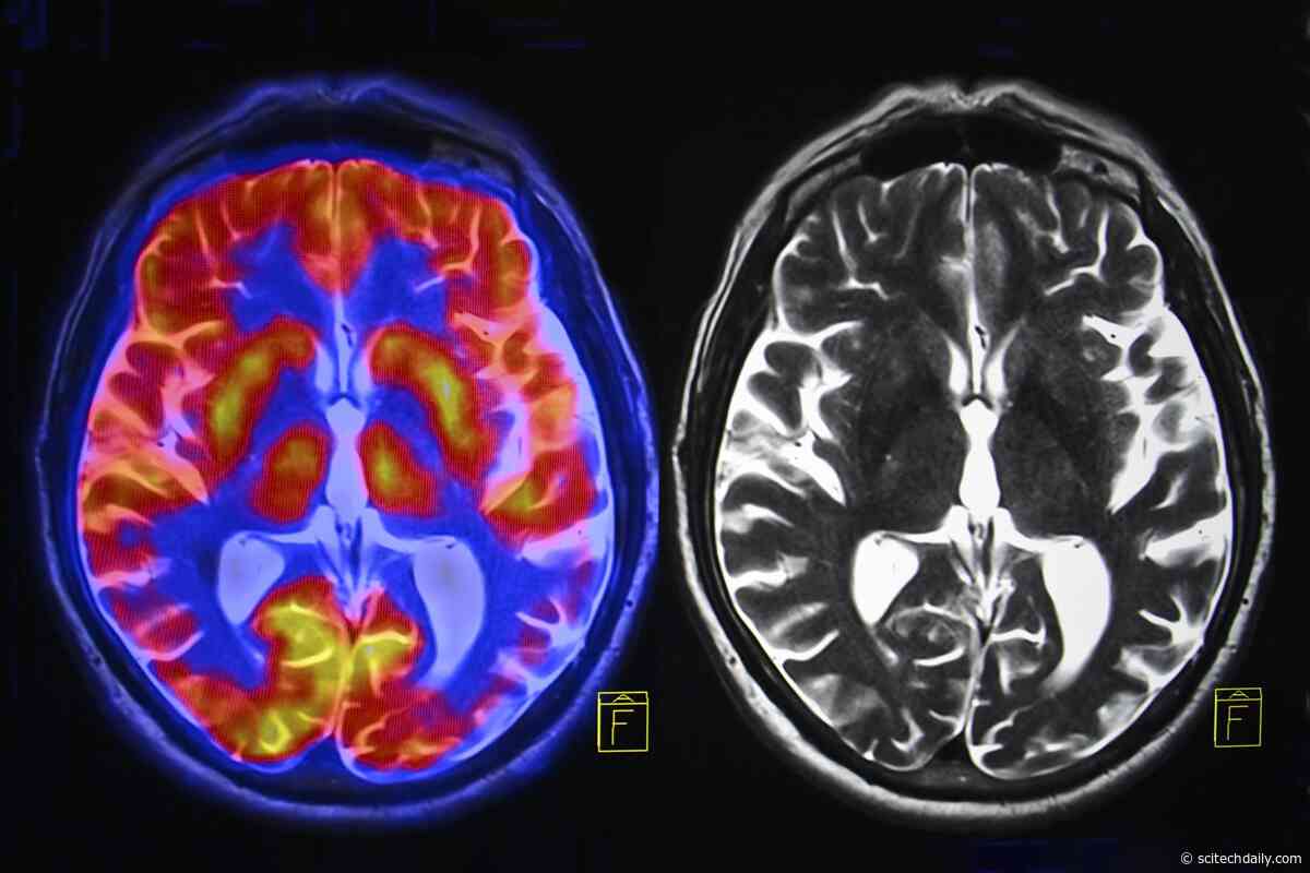 Researchers Suspected Brain Inflammation in Long COVID but Found Something Else