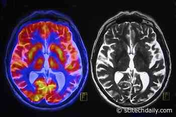 Researchers Suspected Brain Inflammation in Long COVID but Found Something Else