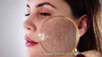 Rosazea: Dermatologe klärt über Symptome und Behandlung auf