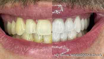 Smoker spends 20p-a-day and 'badly stained teeth' changed 'straight away'