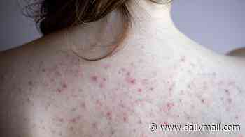 Dermatologists' guide to bacne: What causes unsightly and painful spots on your back and how to get rid of them... fast