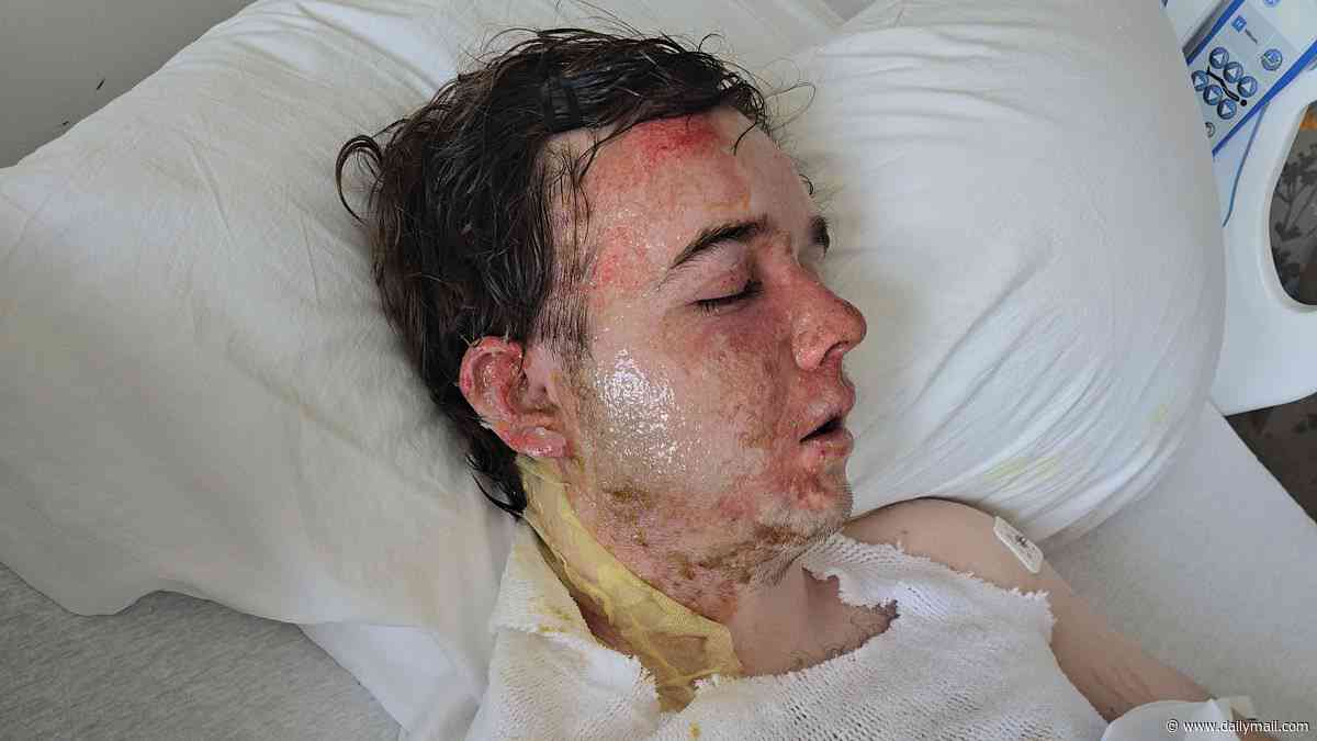 McDonald's manager left with scorching second-degree burns after coworker allegedly throws burning hot OIL at him ahead of his wedding