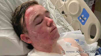 McDonald’s worker suffers severe burns after coworker throws hot oil on him