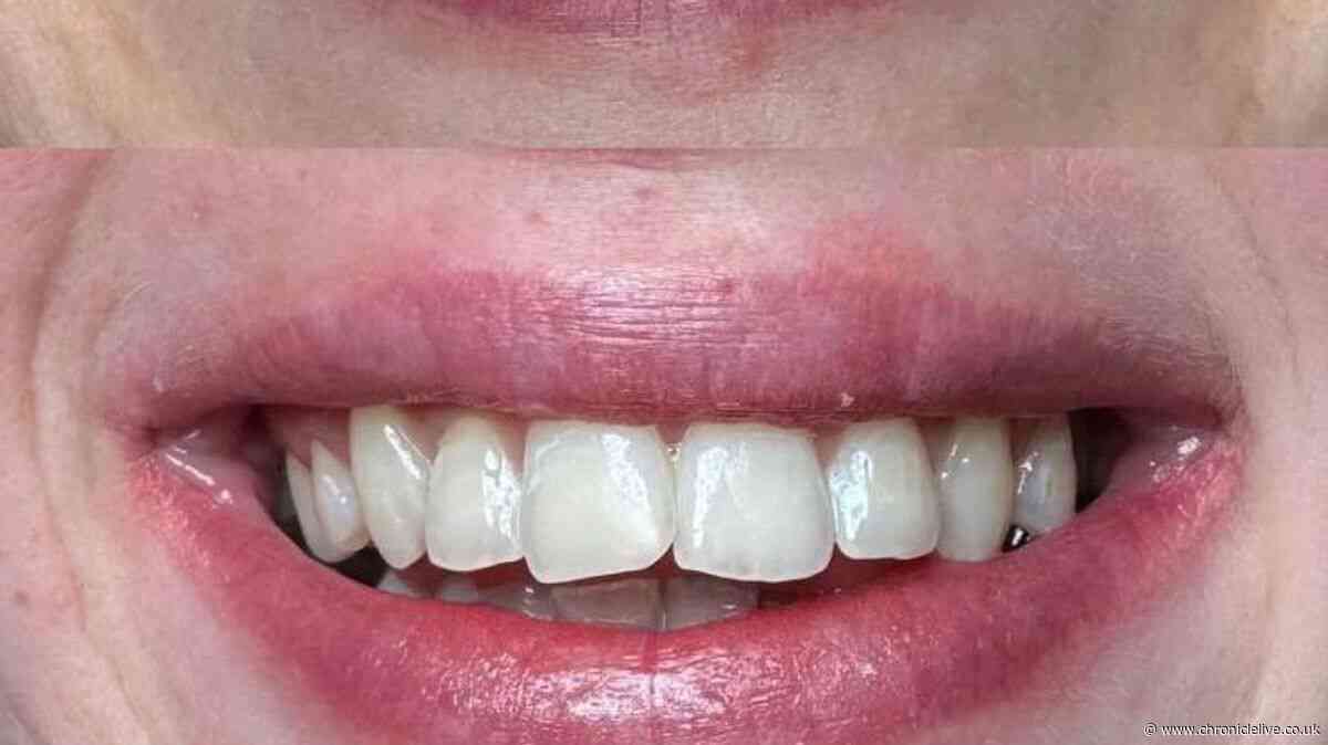 'I've used these 70p strips for 10 days and my teeth got whiter after each use'