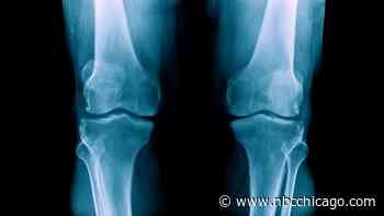 Doctor hopes a simple scan will can help more women avoid osteoporosis fractures