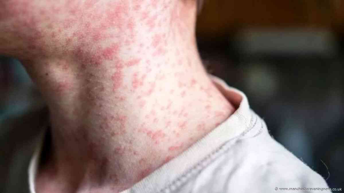 Health chiefs issue warning over 'heartbreaking' disease after two measles deaths