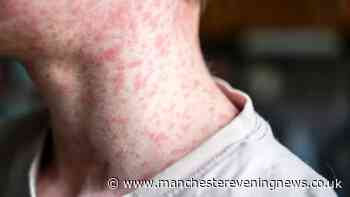 Health chiefs issue warning over 'heartbreaking' disease after two measles deaths