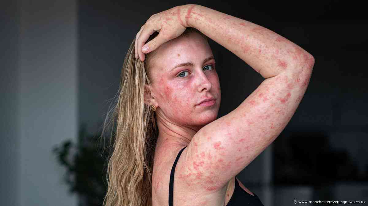 'Doctors gave me cream for my eczema - now showers feel like acid is being poured over me'