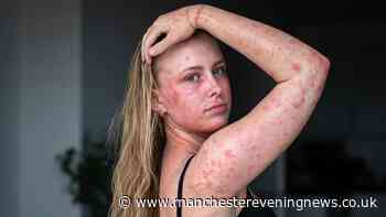 'Doctors gave me cream for my eczema - now showers feel like acid is being poured over me'