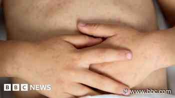 Two children die from measles following outbreaks