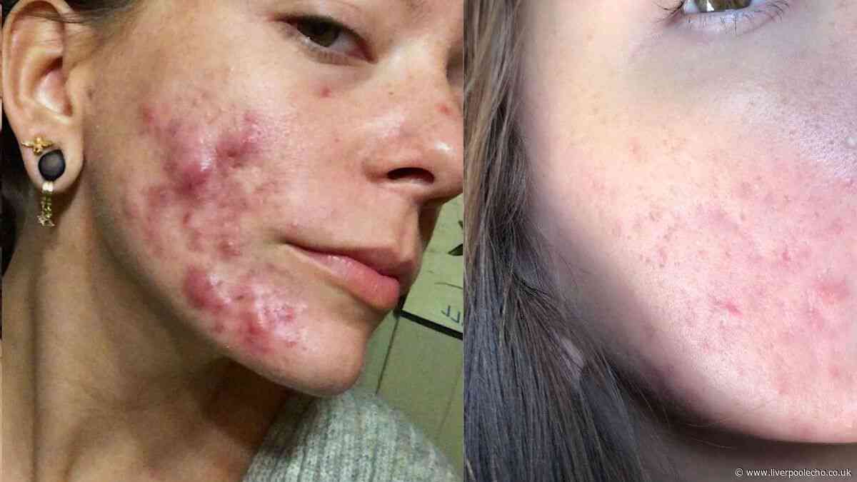 'I wouldn't leave home' before £16 spot serum that 'got confidence back in 2 weeks'