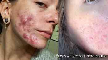 'I wouldn't leave home' before £16 spot serum that 'got confidence back in 2 weeks'
