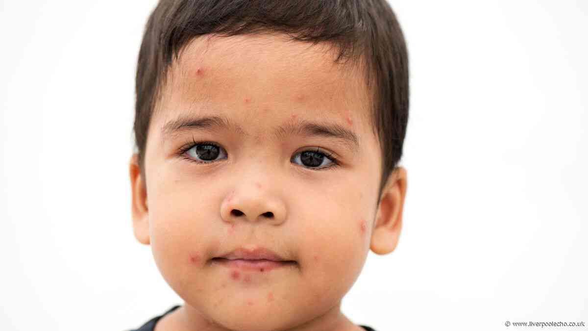 Measles symptoms warning to parents as cases rise and two die - full list