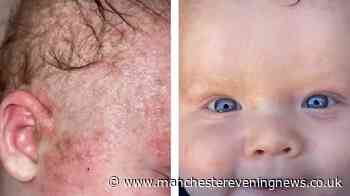 Mum 'astonished' by £2 balm she claims cleared her baby's painful eczema 'in days'