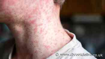 UK measles update with urgent warning to parents as over 100 new cases confirmed