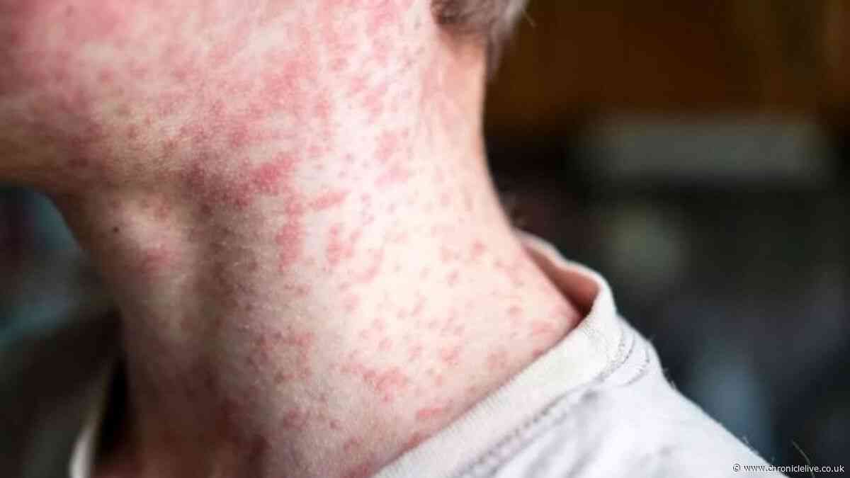 UK measles update with urgent warning to parents as over 100 new cases confirmed