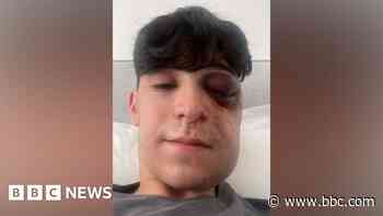 Man's jaw broken in random attack after late shift