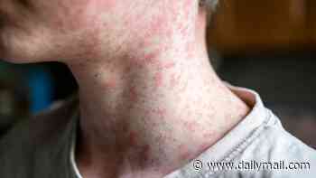 Measles surge in Utah sparks fears US could undo decades of progress and jeopardize elimination status