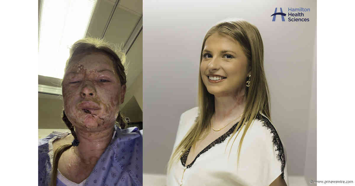 World-first burn treatment with "absolutely remarkable" results performed at leading Canadian hospital