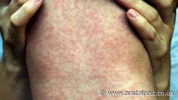 Bristol parents warned after measles kills two children in England