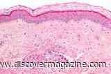 Weight Loss Drugs Like Ozempic May Lower Breast Cancer Risk and Slow Disease Progression