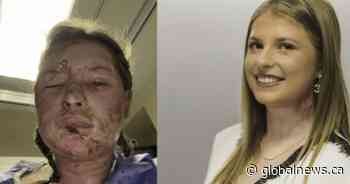 World-first burn treatment shows ‘remarkable’ results in Canadian patient