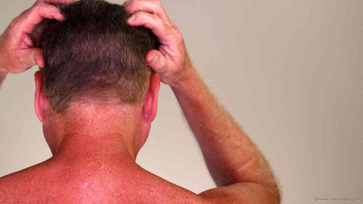 Dandruff warning as ‘neglected’ sunscreen spot can raise cancer risk
