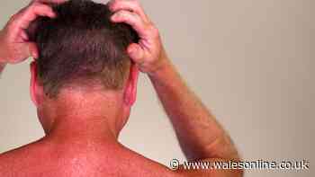 Dandruff warning as ‘neglected’ sunscreen spot can raise cancer risk