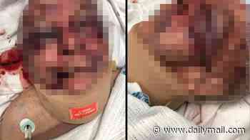 Elderly man hospitalised with severe head injuries after alleged assault at Sydney nursing home