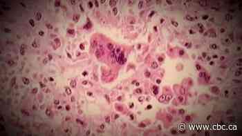 Peel Public Health investigating measles exposure on June 13