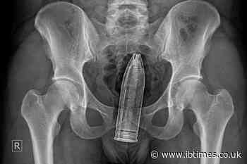 French Hospital Evacuated After Doctors Found World War I Artillery Shell Inside 24-Year-Old Man