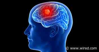 3 People Have Gotten Cancer-Detecting Implants in Their Brains