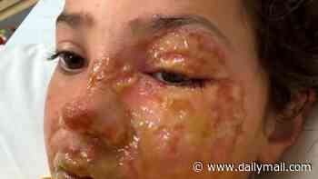 Father's urgent warning after his daughter, 10, suffered horrific burns to her face from viral squishy toy trend popular on TikTok