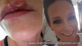 Mum says 'my daughter hasn't had a single cold sore' since using £9 'miracle' balm