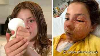 Doctor's urgent warning after girl, 10, suffered horrific burns to her face from viral toy trend