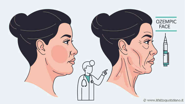 “Guance infossate, pelle flaccida, occhi sporgenti: il viso si svuota in modo innaturale ed è molto difficile recuperare tonicità”: così l'”Ozempic Face” sta cambiando i protocolli di medicina estetica