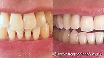 Over 60s with 'yellow teeth' are buying £10 whitener 'for myself and my friend'