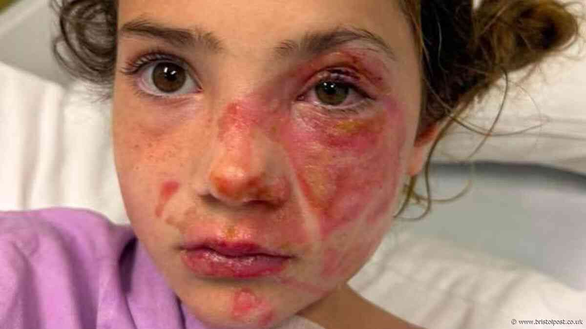 Parents warned after toy leaves children badly burned